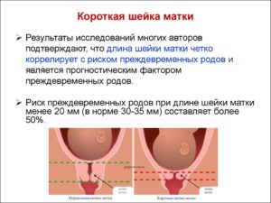 Матка короткая при беременности