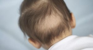 Почему у новорожденных выпадают волосы