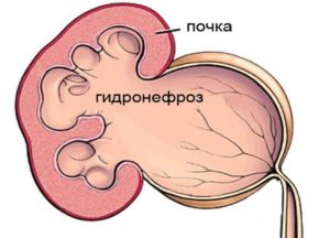 В почках застой мочи