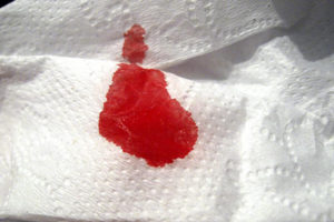 Кровотечение после родов через месяц ярко красные