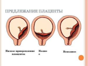 Низкая плацентация и роды