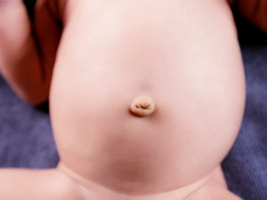 У новорожденного широкое пупочное кольцо