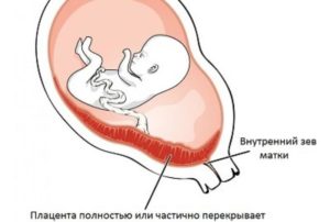 Хорион по передней стенке до края внутреннего зева