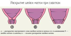 Сглажена шейка что значит