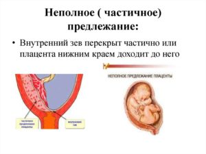 Хорион по передней стенке до края внутреннего зева