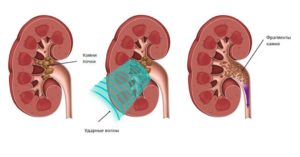 В почках застой мочи