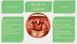 38 неделя беременности болит горло чем лечить