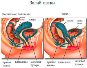 Беременность и загнутая матка