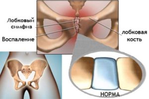 При беременности ноет лобковая кость