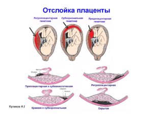 При беременности отошла плацента