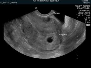 Можно ли на узи перепутать миому с беременностью