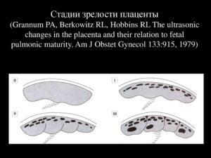 Раннее созревание плаценты на 32 неделе 2 стадия