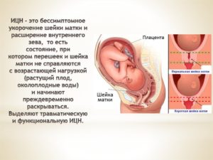 При беременности матка укороченная