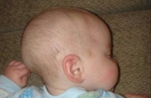 Почему у новорожденного вытянутая голова