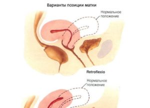 Ретрофлексия матки и беременность