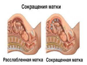 Что делать если матка плохо сокращается после родов