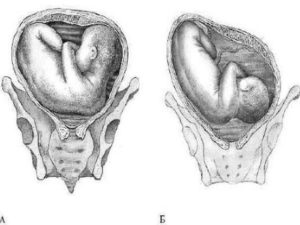 Тазовое косое предлежание плода