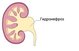 При беременности расширение лоханки