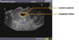 На каком сроке плодное яйцо опускается в матку