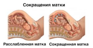 Почему на ранних сроках беременности матка в тонусе