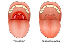 38 неделя беременности болит горло чем лечить