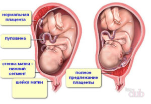 Низкое прикрепление плаценты по передней стенке матки