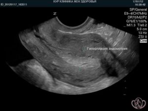 Беременность после гиперплазии эндометрия