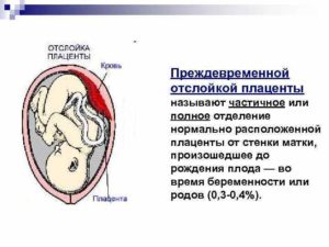 Отошла плацента при беременности