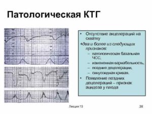 При ктг 1 децелерация