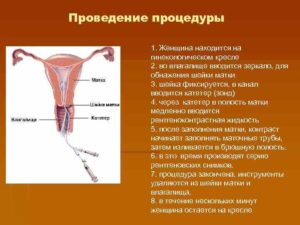 Вставили катетер в шейку матки