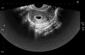 На какой неделе беременности видно эмбрион на узи