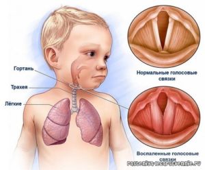 Лорингический кашель у ребенка чем лечить