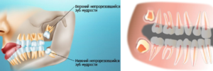 Растет зуб мудрости у беременной