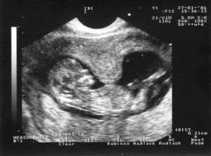 Гипертонус задней стенки матки при беременности 13 недель