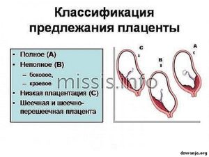 Предлежание плаценты 20 недель