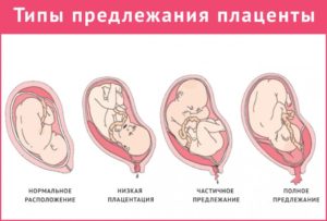 Что значит низкая плацентация при беременности 20 недель