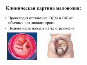 Маловодие при беременности 34