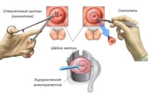 Можно ли делать биопсию шейки матки при беременности