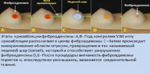 После удаления фиброаденомы молочной железы когда можно беременеть