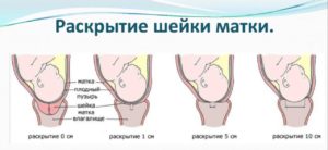 Раскрытие шейки матки на 1 палец когда рожать