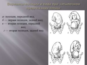 Головное предлежание плода 1 позиция передний вид