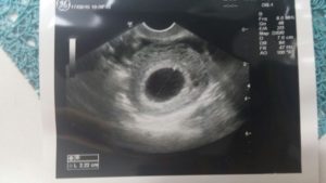 5 неделя беременности на узи не видно эмбриона