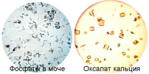 В моче аморфные фосфаты при беременности что это