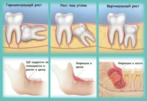 Растет зуб мудрости при беременности