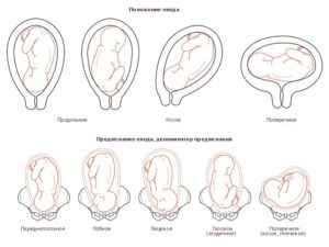 Что значит продольное предлежание плода головное предлежание