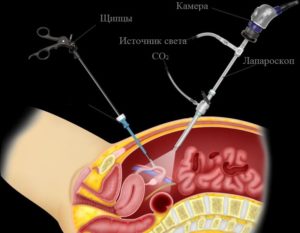 Стимуляция яичников после лапароскопии