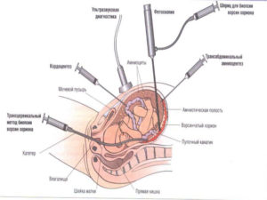 Биопсия хориона что это такое