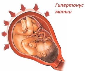 Тонус матки вне беременности