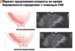 Плацента утолщена при беременности