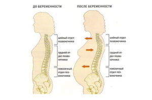 20 неделя беременности болит поясница